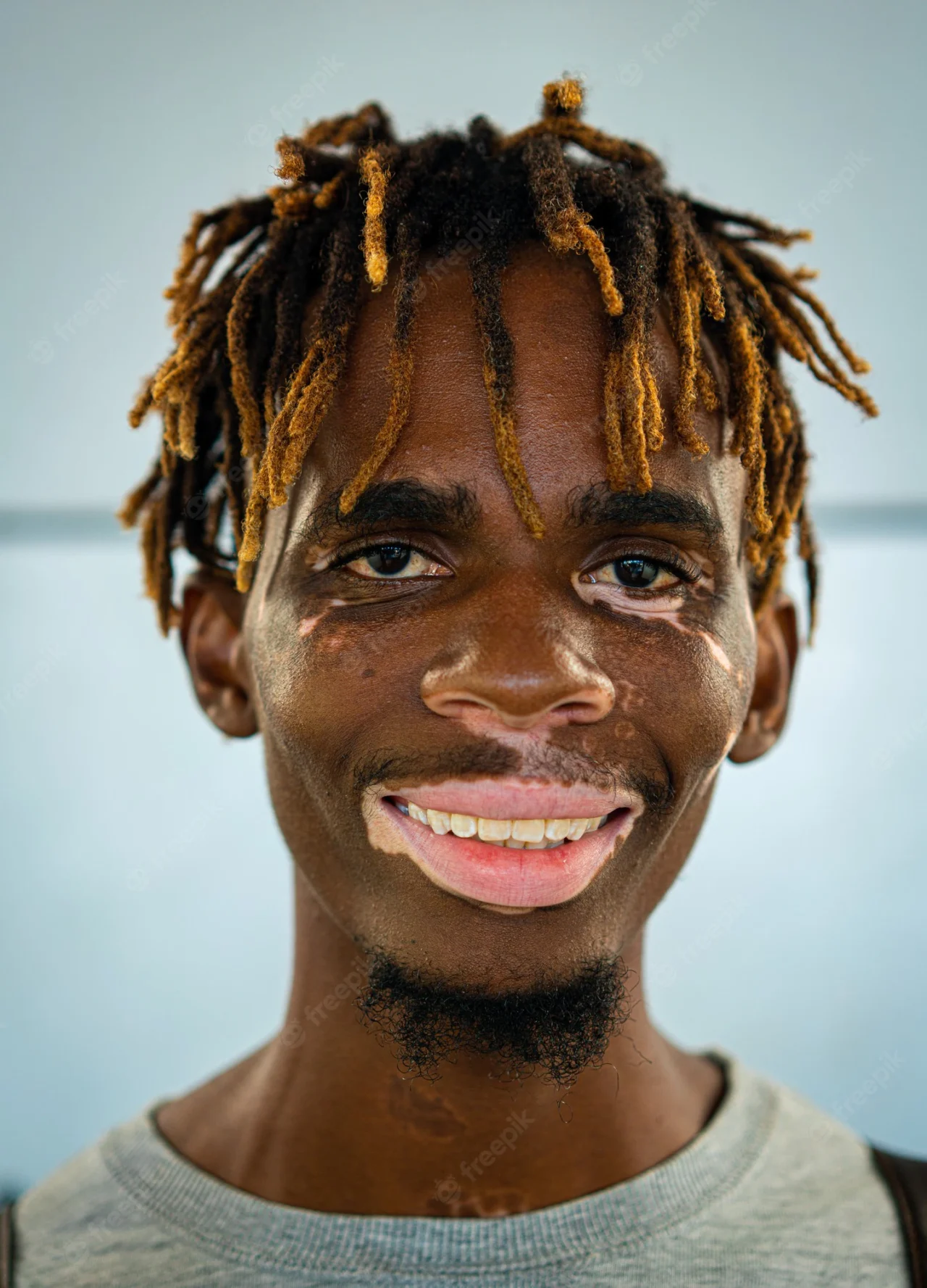 african-american-black-young-man-with-vitiligo-skin_21730-14522-1280x1777.webp