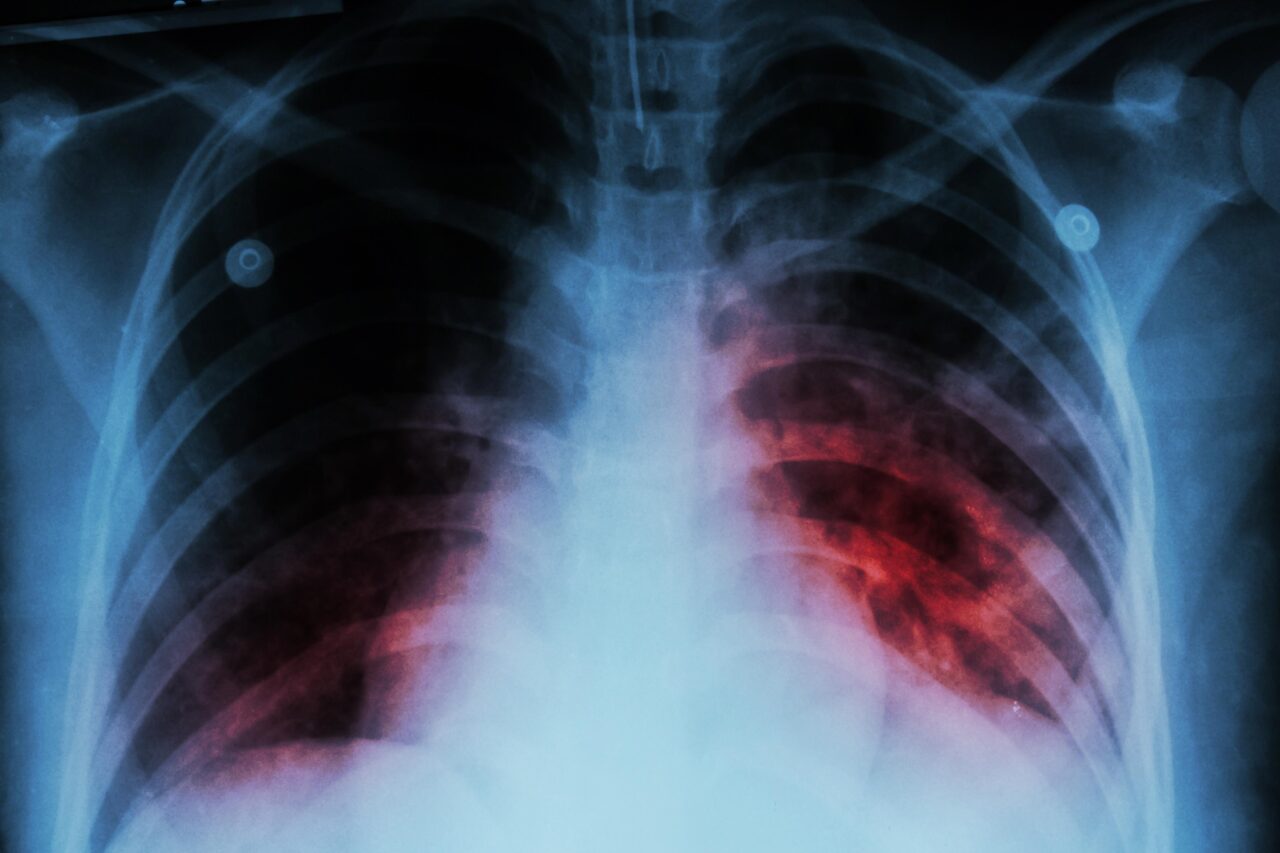 Tuberculosis_share-1280x853.jpg